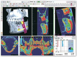 歯科用ＣＴ