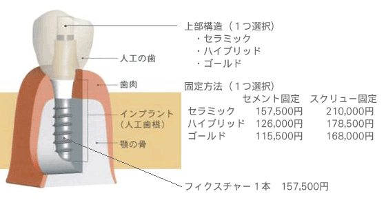 インプラントの構造と料金