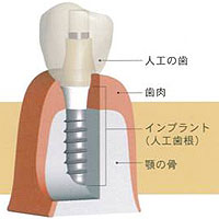 インプラントの構造