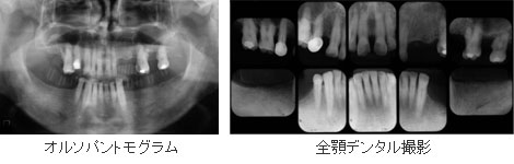 オルソパントモグラム 全顎デンタル撮影
