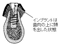 1回法インプラント