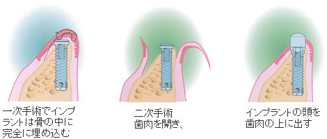 2回法インプラントの二次手術